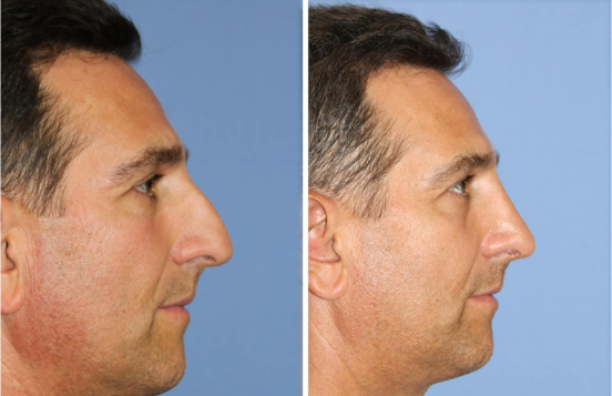 avant après rhinoplastie 