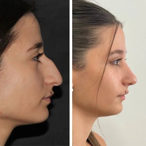 avant apres rhinoplastie bosse femme cas 1