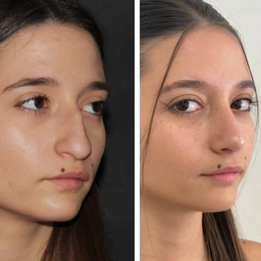 avant apres rhinoplastie bosse femme face