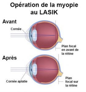 Presbylasik : Chirurgie laser de la presbytie - Actualités