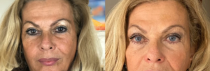 changement couleur yeux kératopigmentation