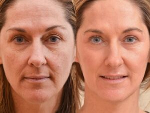 lifting visage tunisie sans chirurgie avec endolift et laser co2