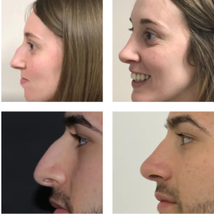 maroc rhinoplastie ultrasonique 